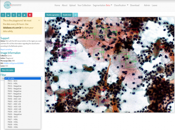 This screenshot from the CRIC database shows several HSIL (high grade squamous intraepithelial lesions), which are lesions of a pre-cancerous disease.